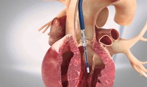 stenosi-della-valvola-aortica-i-vantaggi-della-procedura-tavi-770x459