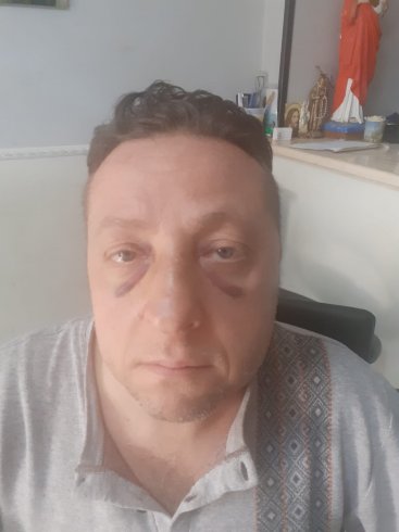 Fratture alla costola e alla mascella, aggredito un dipendente di Salerno Pulita a via Vernieri - aSalerno.it